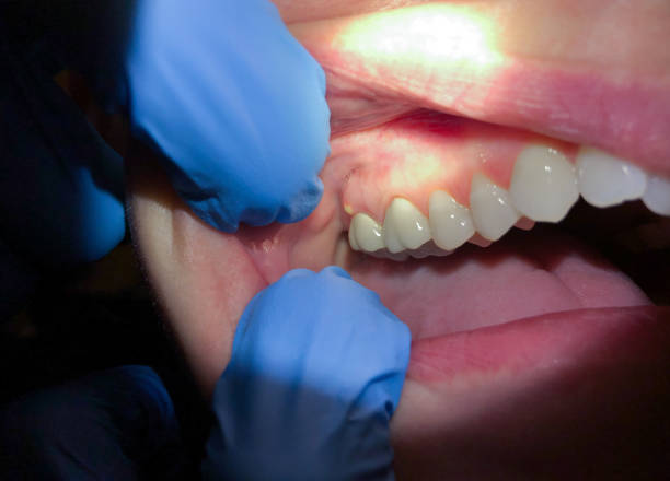 Best Emergency Root Canal Treatment in Calabash, NC